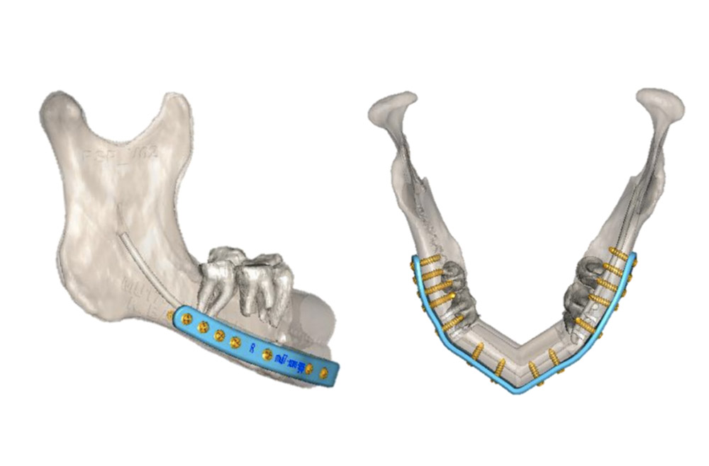 VSP for Patient-Specific Reconstructive Microsurgery Case Study Figure 3a